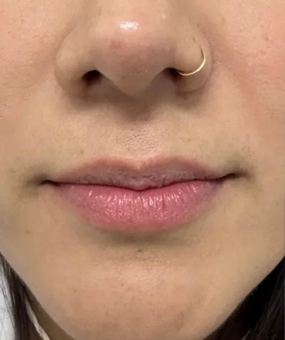 Aumento de labios, caso 1: antes