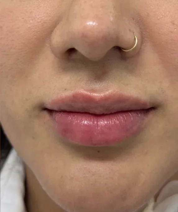 Aumento de labios, caso 1: después